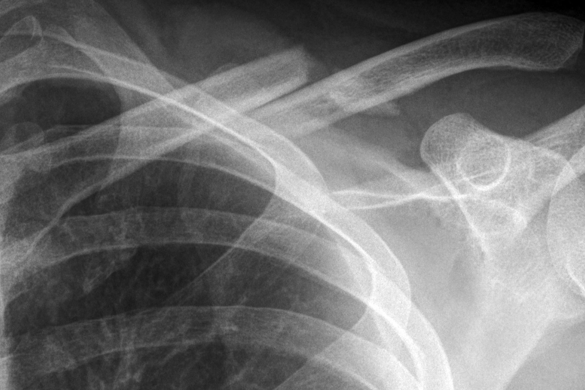 the Newest Member of the Collarbone Club Asphalt & Rubber